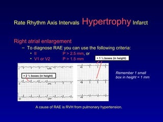 Rate Rhythm Axis Intervals Hypertrophy Infarct
Right atrial enlargement
– To diagnose RAE you can use the following criteria:
• II P > 2.5 mm, or
• V1 or V2 P > 1.5 mm
Remember 1 small
box in height = 1 mm
A cause of RAE is RVH from pulmonary hypertension.
> 2 ½ boxes (in height)
> 1 ½ boxes (in height)
 