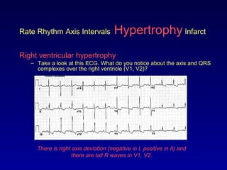 Rate Rhythm Axis Intervals Hypertrophy Infarct
Right ventricular hypertrophy
– Take a look at this ECG. What do you notice about the axis and QRS
complexes over the right ventricle (V1, V2)?
There is right axis deviation (negative in I, positive in II) and
there are tall R waves in V1, V2.
 