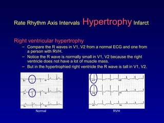 Rate Rhythm Axis Intervals Hypertrophy Infarct
Right ventricular hypertrophy
– Compare the R waves in V1, V2 from a normal ECG and one from
a person with RVH.
– Notice the R wave is normally small in V1, V2 because the right
ventricle does not have a lot of muscle mass.
– But in the hypertrophied right ventricle the R wave is tall in V1, V2.
Normal RVH
 