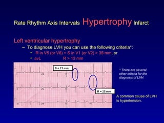 Rate Rhythm Axis Intervals Hypertrophy Infarct
Left ventricular hypertrophy
– To diagnose LVH you can use the following criteria*:
• R in V5 (or V6) + S in V1 (or V2) > 35 mm, or
• avL R > 13 mm
A common cause of LVH
is hypertension.
* There are several
other criteria for the
diagnosis of LVH.
S = 13 mm
R = 25 mm
 