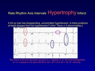 Rate Rhythm Axis Intervals Hypertrophy Infarct
A 63 yo man has longstanding, uncontrolled hypertension. Is there evidence
of heart disease from his hypertension? (Hint: There a 3 abnormalities.)
Yes, there is left axis deviation (positive in I, negative in II), left atrial enlargement
(> 1 x 1 boxes in V1) and LVH (R in V5 = 27 + S in V2 = 10  > 35 mm).
 