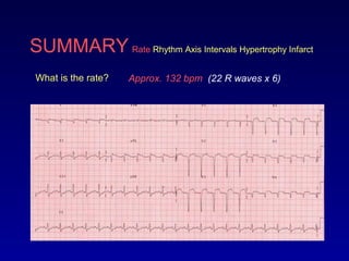 SUMMARY Rate Rhythm Axis Intervals Hypertrophy Infarct
What is the rate? Approx. 132 bpm (22 R waves x 6)
 