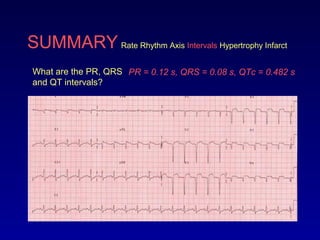 SUMMARY Rate Rhythm Axis Intervals Hypertrophy Infarct
What are the PR, QRS
and QT intervals?
PR = 0.12 s, QRS = 0.08 s, QTc = 0.482 s
 
