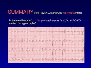 SUMMARY Rate Rhythm Axis Intervals Hypertrophy Infarct
Is there evidence of
ventricular hypertrophy?
No (no tall R waves in V1/V2 or V5/V6)
 