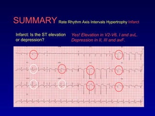 SUMMARY Rate Rhythm Axis Intervals Hypertrophy Infarct
Infarct: Is the ST elevation
or depression?
Yes! Elevation in V2-V6, I and avL.
Depression in II, III and avF.
 