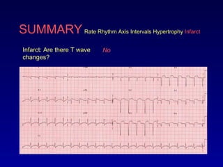 SUMMARY Rate Rhythm Axis Intervals Hypertrophy Infarct
Infarct: Are there T wave
changes?
No
 