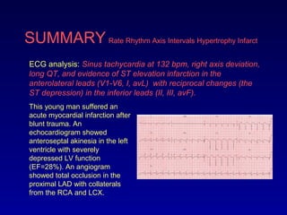 SUMMARY Rate Rhythm Axis Intervals Hypertrophy Infarct
ECG analysis: Sinus tachycardia at 132 bpm, right axis deviation,
long QT, and evidence of ST elevation infarction in the
anterolateral leads (V1-V6, I, avL) with reciprocal changes (the
ST depression) in the inferior leads (II, III, avF).
This young man suffered an
acute myocardial infarction after
blunt trauma. An
echocardiogram showed
anteroseptal akinesia in the left
ventricle with severely
depressed LV function
(EF=28%). An angiogram
showed total occlusion in the
proximal LAD with collaterals
from the RCA and LCX.
 