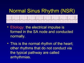Normal Sinus Rhythm (NSR)
• Etiology: the electrical impulse is
formed in the SA node and conducted
normally.
• This is the normal rhythm of the heart;
other rhythms that do not conduct via
the typical pathway are called
arrhythmias.
 
