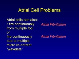 Atrial Cell Problems
Atrial cells can also:
• fire continuously
from multiple foci
or
fire continuously
due to multiple
micro re-entrant
“wavelets”
Atrial Fibrillation
Atrial Fibrillation
 