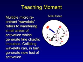 Teaching Moment
Multiple micro re-
entrant “wavelets”
refers to wandering
small areas of
activation which
generate fine chaotic
impulses. Colliding
wavelets can, in turn,
generate new foci of
activation.
Atrial tissue
 