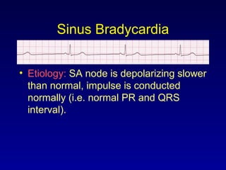 Sinus Bradycardia
• Etiology: SA node is depolarizing slower
than normal, impulse is conducted
normally (i.e. normal PR and QRS
interval).
 