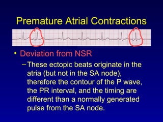 Premature Atrial Contractions
• Deviation from NSR
–These ectopic beats originate in the
atria (but not in the SA node),
therefore the contour of the P wave,
the PR interval, and the timing are
different than a normally generated
pulse from the SA node.
 