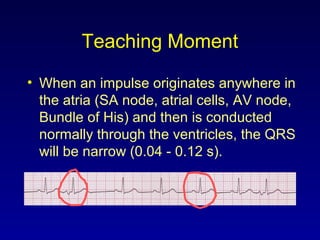 Teaching Moment
• When an impulse originates anywhere in
the atria (SA node, atrial cells, AV node,
Bundle of His) and then is conducted
normally through the ventricles, the QRS
will be narrow (0.04 - 0.12 s).
 