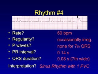 Rhythm #4
60 bpm• Rate?
• Regularity? occasionally irreg.
none for 7th QRS
0.08 s (7th wide)
• P waves?
• PR interval? 0.14 s
• QRS duration?
Interpretation? Sinus Rhythm with 1 PVC
 