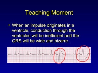 Teaching Moment
• When an impulse originates in a
ventricle, conduction through the
ventricles will be inefficient and the
QRS will be wide and bizarre.
 