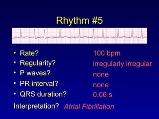 Rhythm #5
100 bpm• Rate?
• Regularity? irregularly irregular
none
0.06 s
• P waves?
• PR interval? none
• QRS duration?
Interpretation? Atrial Fibrillation
 