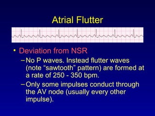 Atrial Flutter
• Deviation from NSR
–No P waves. Instead flutter waves
(note “sawtooth” pattern) are formed at
a rate of 250 - 350 bpm.
–Only some impulses conduct through
the AV node (usually every other
impulse).
 