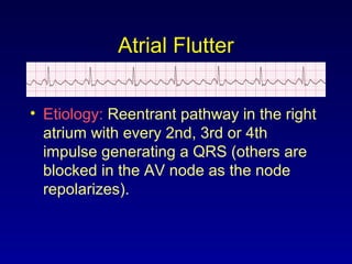 Atrial Flutter
• Etiology: Reentrant pathway in the right
atrium with every 2nd, 3rd or 4th
impulse generating a QRS (others are
blocked in the AV node as the node
repolarizes).
 