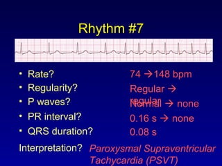 Rhythm #7
74 148 bpm• Rate?
• Regularity? Regular 
regularNormal  none
0.08 s
• P waves?
• PR interval? 0.16 s  none
• QRS duration?
Interpretation? Paroxysmal Supraventricular
Tachycardia (PSVT)
 