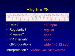 Rhythm #8
160 bpm• Rate?
• Regularity? regular
none
wide (> 0.12 sec)
• P waves?
• PR interval? none
• QRS duration?
Interpretation? Ventricular Tachycardia
 