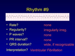 Rhythm #9
none• Rate?
• Regularity? irregularly irreg.
none
wide, if recognizable
• P waves?
• PR interval? none
• QRS duration?
Interpretation? Ventricular Fibrillation
 