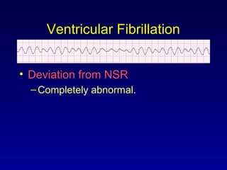Ventricular Fibrillation
• Deviation from NSR
–Completely abnormal.
 