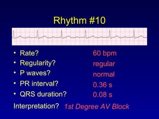 Rhythm #10
60 bpm• Rate?
• Regularity? regular
normal
0.08 s
• P waves?
• PR interval? 0.36 s
• QRS duration?
Interpretation? 1st Degree AV Block
 