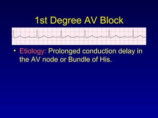 1st Degree AV Block
• Etiology: Prolonged conduction delay in
the AV node or Bundle of His.
 