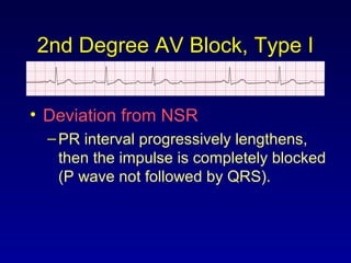 2nd Degree AV Block, Type I
• Deviation from NSR
–PR interval progressively lengthens,
then the impulse is completely blocked
(P wave not followed by QRS).
 