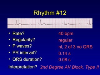 Rhythm #12
40 bpm• Rate?
• Regularity? regular
nl, 2 of 3 no QRS
0.08 s
• P waves?
• PR interval? 0.14 s
• QRS duration?
Interpretation? 2nd Degree AV Block, Type II
 