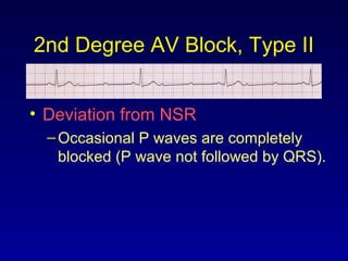 2nd Degree AV Block, Type II
• Deviation from NSR
–Occasional P waves are completely
blocked (P wave not followed by QRS).
 