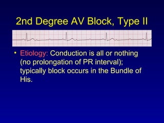 2nd Degree AV Block, Type II
• Etiology: Conduction is all or nothing
(no prolongation of PR interval);
typically block occurs in the Bundle of
His.
 