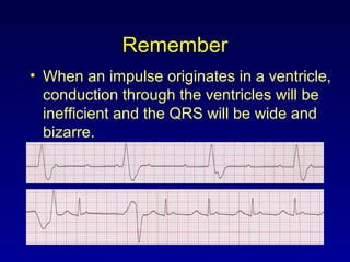 Remember
• When an impulse originates in a ventricle,
conduction through the ventricles will be
inefficient and the QRS will be wide and
bizarre.
 