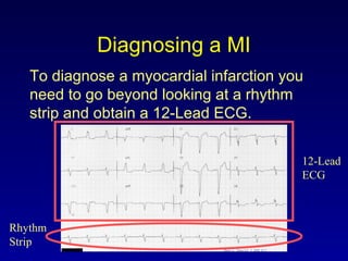 Diagnosing a MI
To diagnose a myocardial infarction you
need to go beyond looking at a rhythm
strip and obtain a 12-Lead ECG.
Rhythm
Strip
12-Lead
ECG
 