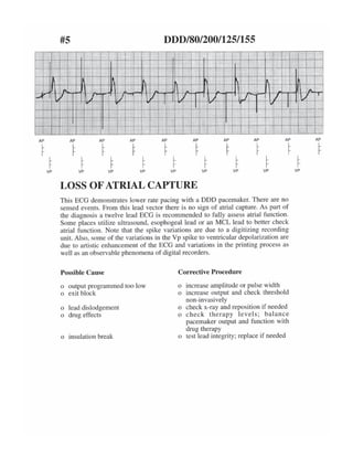 ECG tracing in pacemaker patients | PDF