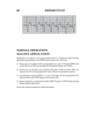 ECG tracing in pacemaker patients | PDF