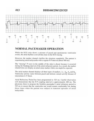 ECG tracing in pacemaker patients | PDF