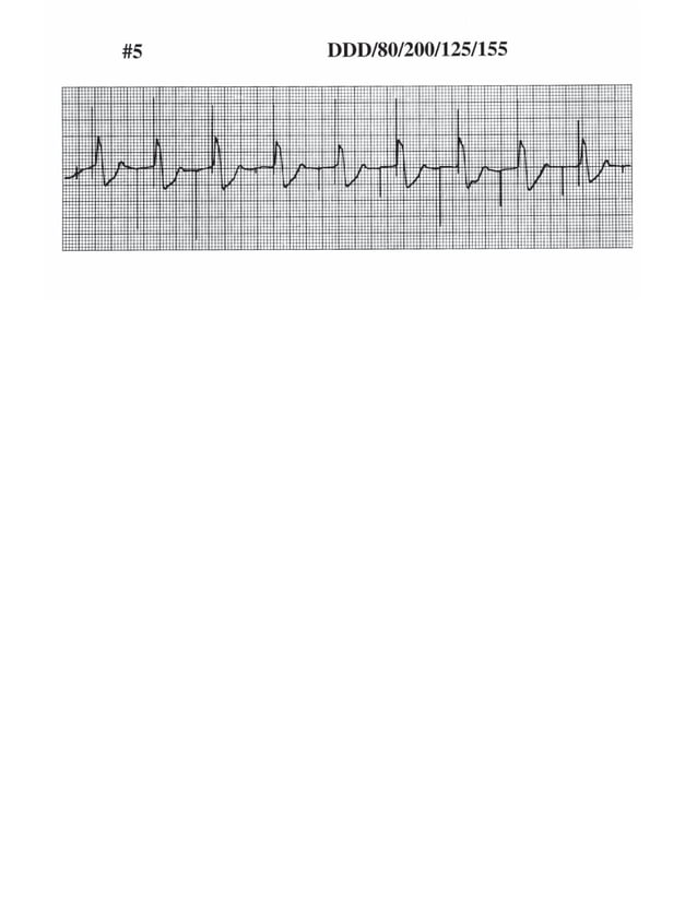 ECG tracing in pacemaker patients | PDF | Heart and Cardiovascular ...