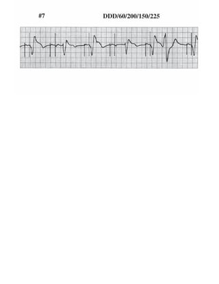 ECG tracing in pacemaker patients | PDF
