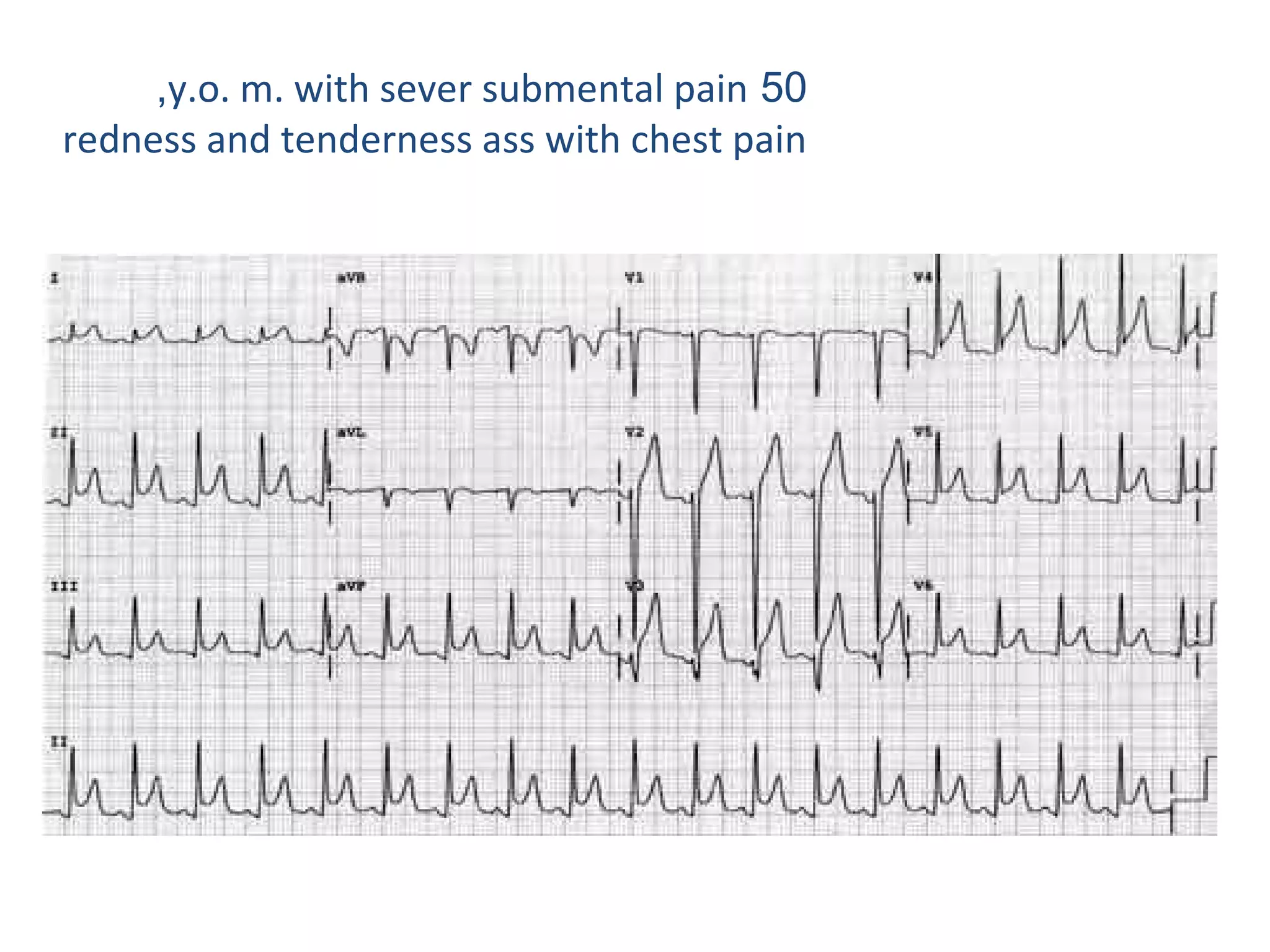 ,y.o. m. with sever submental pain 50
redness and tenderness ass with chest pain

 