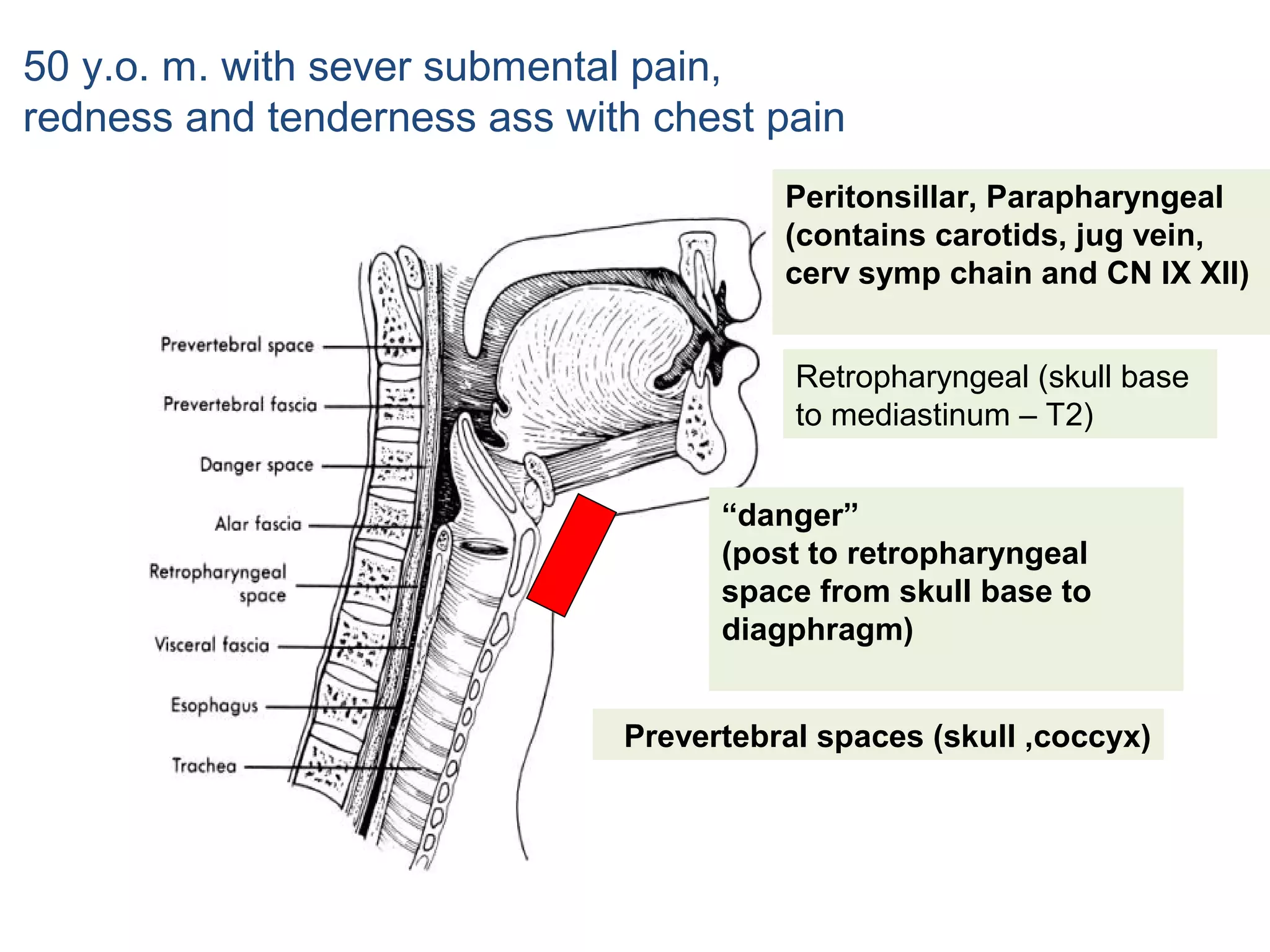 50 y.o. m. with sever submental pain,
redness and tenderness ass with chest pain
Peritonsillar, Parapharyngeal
(contains carotids, jug vein,
cerv symp chain and CN IX XII)
Retropharyngeal (skull base
to mediastinum – T2)
“danger”
(post to retropharyngeal
space from skull base to
diagphragm)
Prevertebral spaces (skull ,coccyx)

 