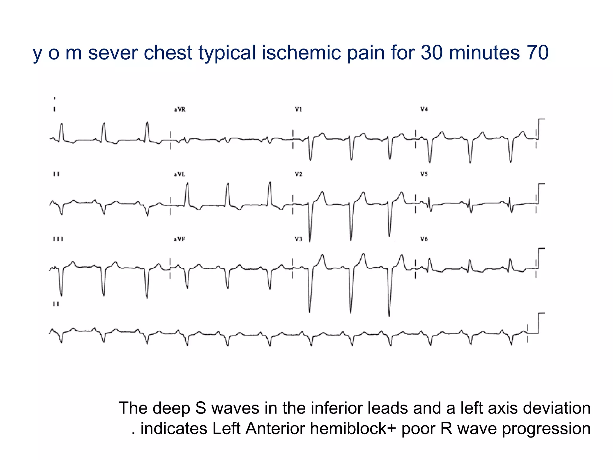 y o m sever chest typical ischemic pain for 30 minutes 70

The deep S waves in the inferior leads and a left axis deviation
. indicates Left Anterior hemiblock+ poor R wave progression

 