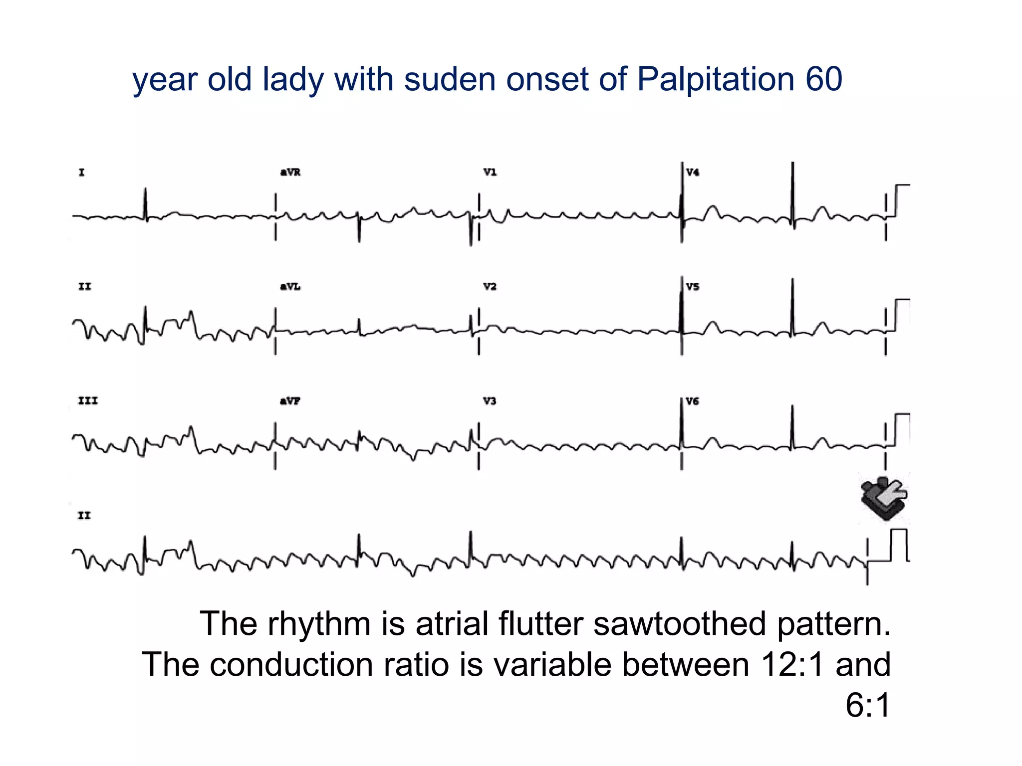 year old lady with suden onset of Palpitation 60

The rhythm is atrial flutter sawtoothed pattern.
The conduction ratio is variable between 12:1 and
6:1

 