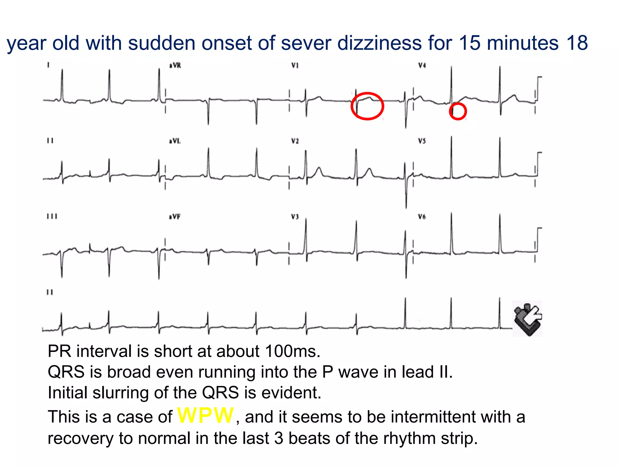 year old with sudden onset of sever dizziness for 15 minutes 18

PR interval is short at about 100ms.
QRS is broad even running into the P wave in lead II.
Initial slurring of the QRS is evident.
This is a case of WPW , and it seems to be intermittent with a
recovery to normal in the last 3 beats of the rhythm strip.

 