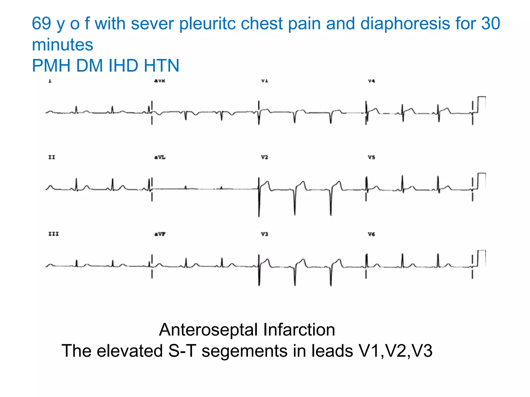 69 y o f with sever pleuritc chest pain and diaphoresis for 30
minutes
PMH DM IHD HTN

Anteroseptal Infarction
The elevated S-T segements in leads V1,V2,V3

 