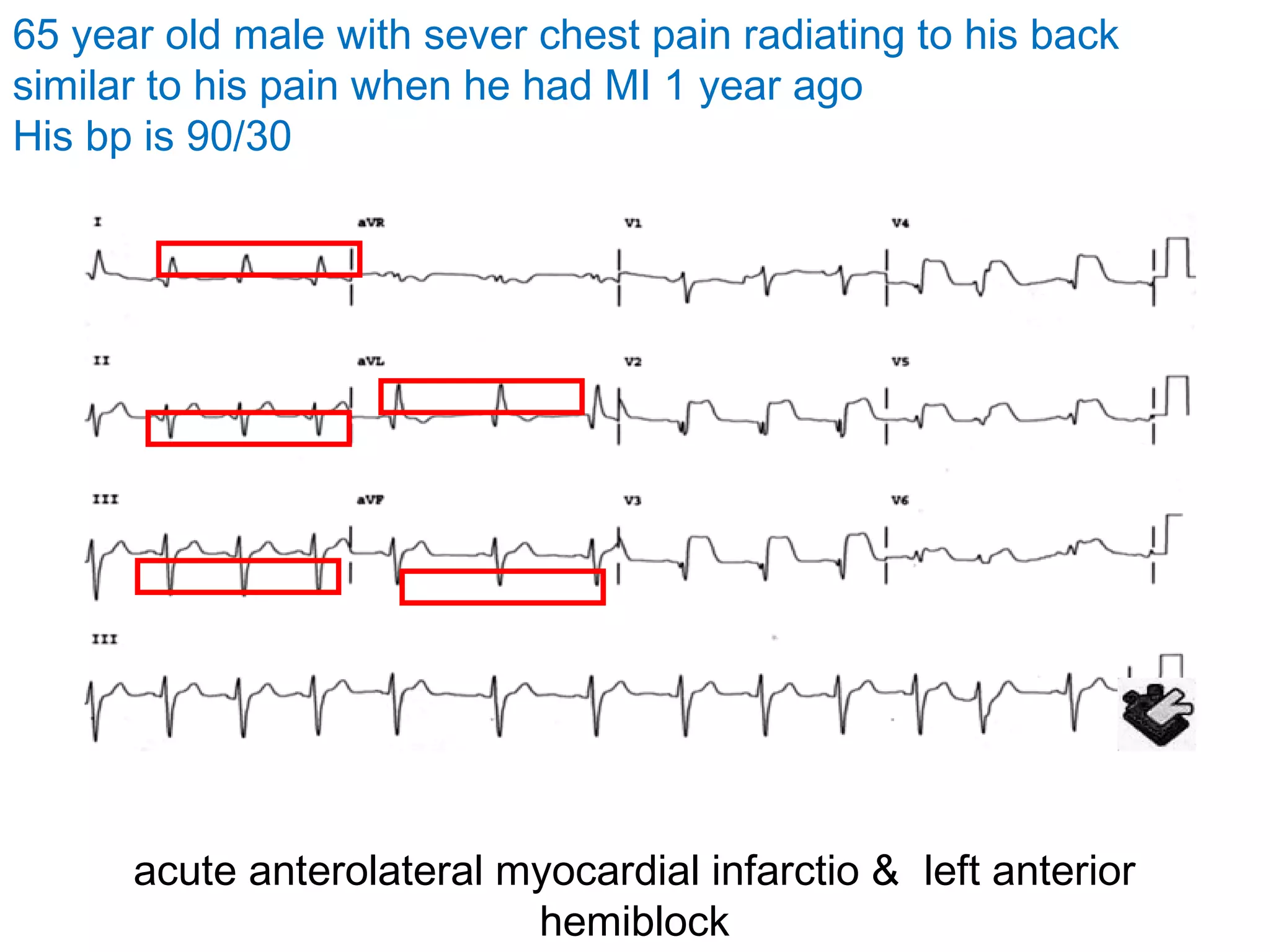 65 year old male with sever chest pain radiating to his back
similar to his pain when he had MI 1 year ago
His bp is 90/30

acute anterolateral myocardial infarctio & left anterior
hemiblock

 