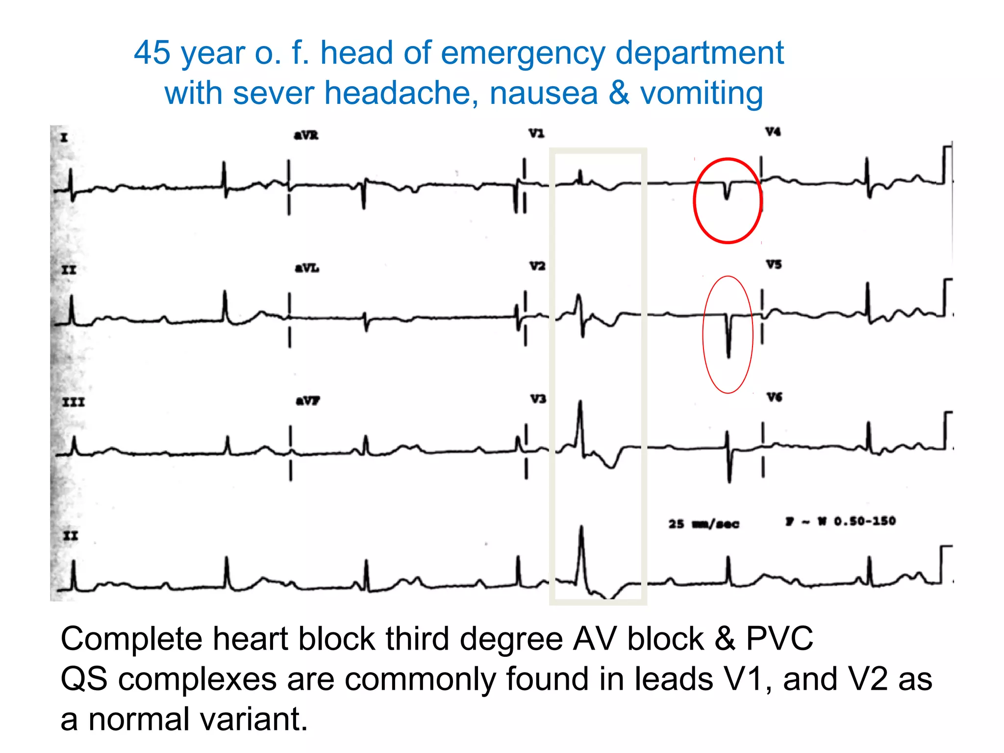 45 year o. f. head of emergency department
with sever headache, nausea & vomiting

Complete heart block third degree AV block & PVC
QS complexes are commonly found in leads V1, and V2 as
a normal variant.

 