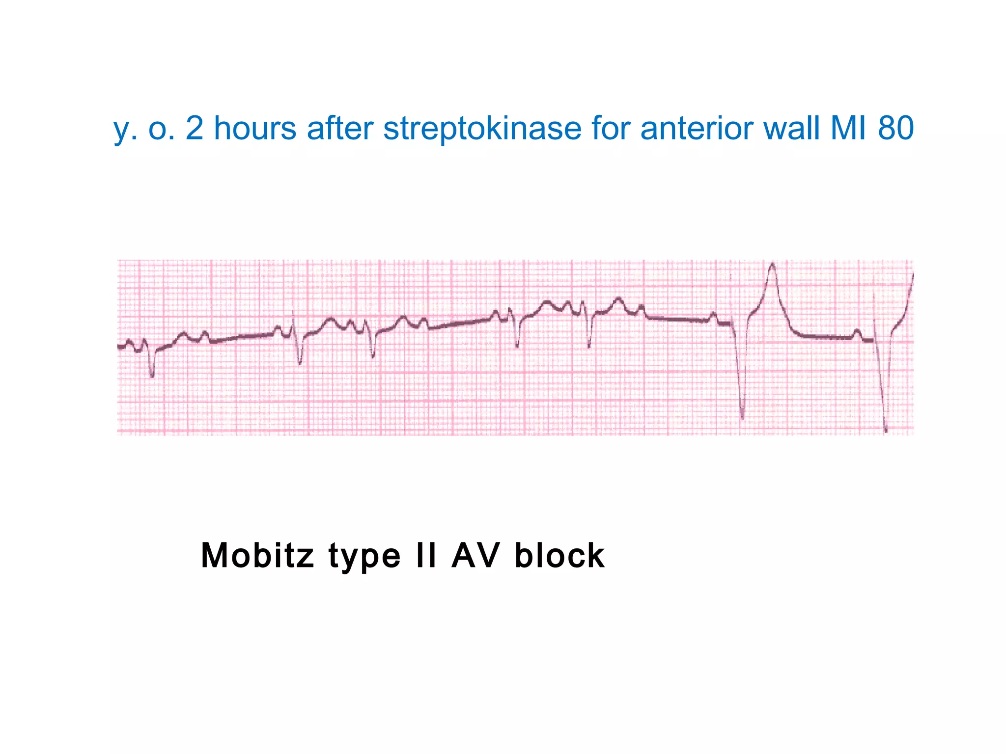 y. o. 2 hours after streptokinase for anterior wall MI 80

Mobitz type II AV block

 