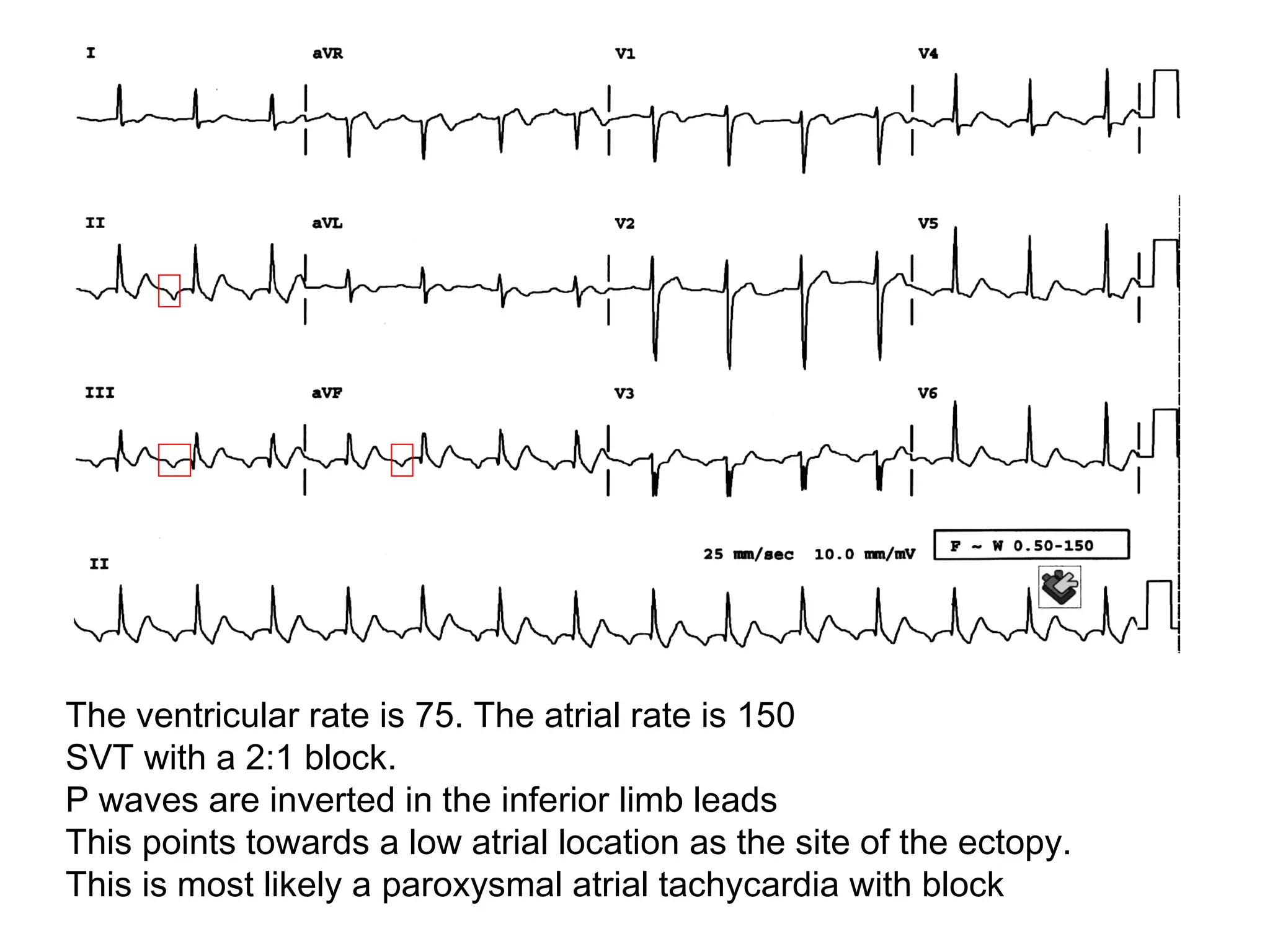 The ventricular rate is 75. The atrial rate is 150
SVT with a 2:1 block.
P waves are inverted in the inferior limb leads
This points towards a low atrial location as the site of the ectopy.
This is most likely a paroxysmal atrial tachycardia with block

 