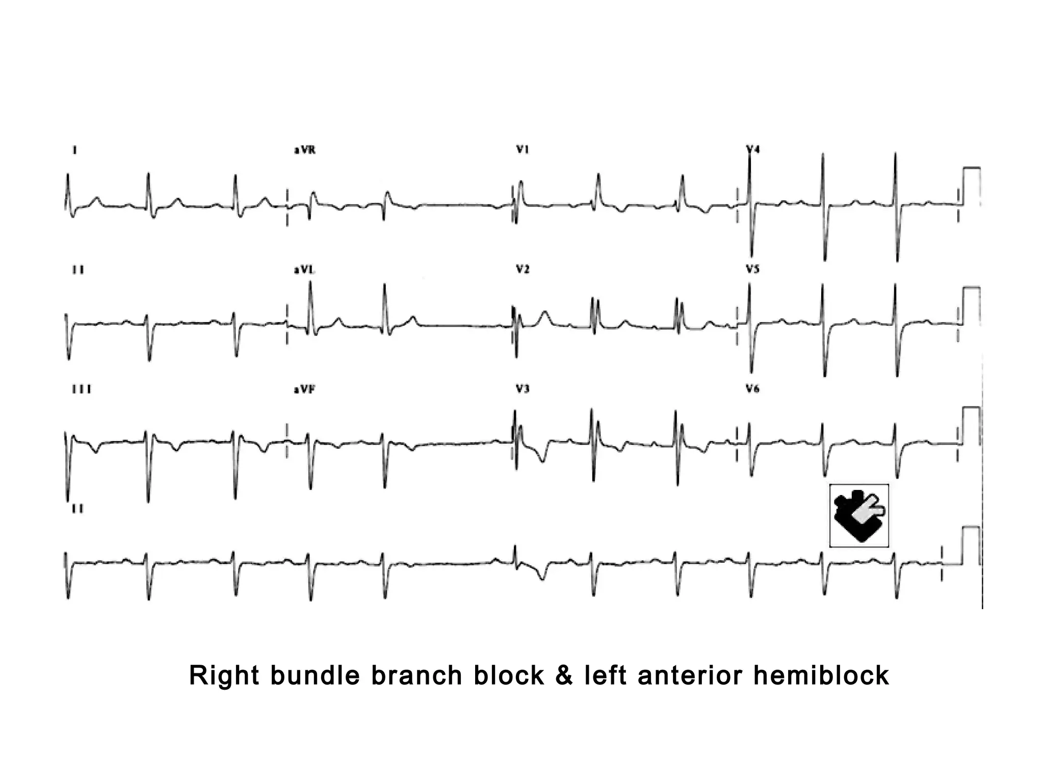 Right bundle branch block & left anterior hemiblock

 
